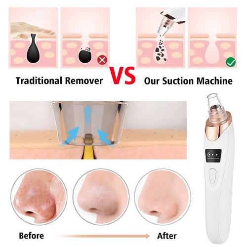 Blackhead Remover Face Acne Black Dot Pimple Electric Black head Vacuum Cleaner Pore Skin Care Tools Machine 4 Replacement Head (random color)
